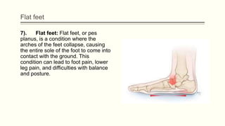 Flat feet
7). Flat feet: Flat feet, or pes
planus, is a condition where the
arches of the feet collapse, causing
the entire sole of the foot to come into
contact with the ground. This
condition can lead to foot pain, lower
leg pain, and difficulties with balance
and posture.
 