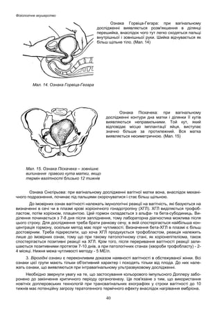 Фізіологічне акушерство

Ознака Горвіца-Гегара: при вагінальному
дослідженні виявляється розм'якшення в ділянці
перешийка, внаслідок чого тут легко сходяться пальці
внутрішньої і зовнішньої руки. Шийка відчувається як
більш щільне тіло. (Мал. 14)

Мал. 14. Ознака Горвіца-Гегара

Ознака Піскачека: при вагінальному
дослідженні контури дна матки і ділянки її кутів
виявляються неправильними. Той кут, який
відповідає місцю імплантації яйця, виступає
значно більше за протилежний. Вся матка
виявляється несиметричною. (Мал. 15)

Мал. 15. Ознака Піскачека – зовнішнє
випинання правого кута матки, якщо
термін вагітності близько 12 тижнів
Ознака Снєгірьова: при вагінальному дослідженні вагітної матки вона, внаслідок механічного подразнення, починає під пальцями скорочуватися і стає більш щільною.
До імовірних ознак вагітності належать імунологічні реакції на вагітність, які базуються на
визначенні в сечі чи в плазмі крові хоріонічного гонадотропіну (ХГЛ). ХГЛ виділяється трофобластом, потім хоріоном, плацентою. Цей гормон складається з альфа- та бета-субодиниць. Виділення починається з 7-8 дня після запліднення, тому лабораторна діагностика можлива після
цього строку. Для дослідження треба брати ранкову сечу, в якій спостерігається найбільша концентрація гормону, оскільки метод має поріг чутливості. Визначення бета-ХГЛ в плазмі є більш
достовірним. Треба підкреслити, що хоча ХГЛ продукується трофобластом, реакція належить
лише до імовірних ознак, тому що при такому патологічному стані, як хоріонепітеліома, також
спостерігається позитивні реакції на ХГЛ. Крім того, після переривання вагітності реакції залишаються позитивними протягом 7-10 днів, а при патологічних станах (хвороби трофобласту) - 24 місяці. Нижня межа чутливості методу - 5 МЕ/л.
3. Вірогідні ознаки є переконливим доказом наявності вагітності в обстежуваної жінки. Всі
ознаки цієї групи мають тільки об'єктивний характер і походять тільки від плода. До них належать ознаки, що виявляються при інтравагінальному ультразвуковому дослідженні.
Необхідно звернути увагу на те, що застосування кольорового імпульсного Доплеру заборонено до закінчення критичного періоду органогенезу. Це пов'язане з тим, що використання
новітніх доплеровських технологій при трансвагінальних ехографіях у строки вагітності до 10
тижнів має потенційну загрозу тератогенного термічного ефекту внаслідок нагрівання ембріона.

40

 