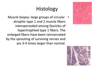 Histology
•
Muscle biopsy: large groups of circular
atrophic type 1 and 2 muscle fibers
intersperseded among fascicles of
hypertrophied type 1 fibers. The
enlarged fibers have been reinnervated
by the sprouting of surviving nerves and
are 3-4 times larger than normal.
 