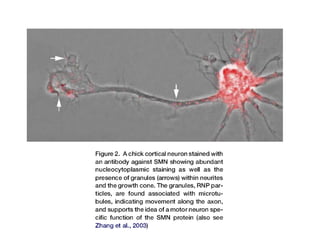 Spinal muscle atrophy SMA: make it easy