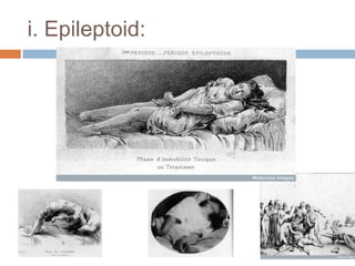 II. “Repression.”The fading of a memory or the loss of an affect is dependent upon:1. Whether there was an energetic relation to the event that caused the affect.      By reaction, it means here a whole serious of voluntary or involuntary reflexes, ranging from crying to an act of revenge, through which according to experience affects are discharged.* If the reaction is suppressed, the affect remains united with the memory.