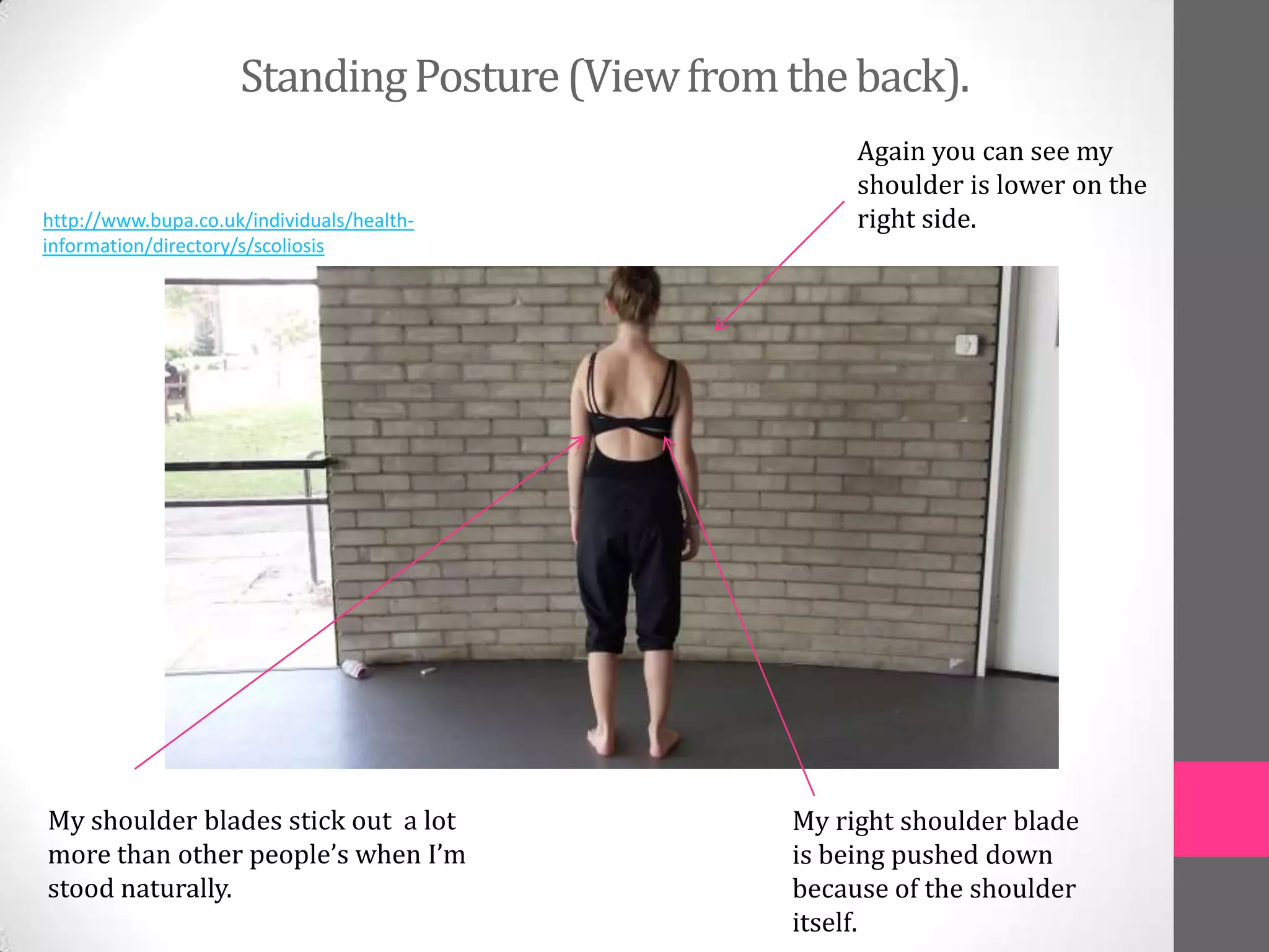 Standing Posture (View from the back).
                                                      Again you can see my
                                                      shoulder is lower on the
http://www.bupa.co.uk/individuals/health-             right side.
information/directory/s/scoliosis




My shoulder blades stick out a lot               My right shoulder blade
more than other people’s when I’m                is being pushed down
stood naturally.                                 because of the shoulder
                                                 itself.
 