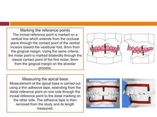 Marking the reference points
The incisal reference point is marked on a
vertical line which extends from the occlusal
plane through the contact point of the central
incisors toward the vestibular fold, 8mm from
the gingival margin. Using the same criteria,
the molar point is marked bilaterally through the
mesial contact point of the first molar, 8mm
from the gingival margin on the alveolar
process.
Measuring the apical base
Measurement of the apical base is carried out
using a thin adhesive tape, extending from the
distal reference point on one side through the
incisal reference point to the distal marking on
the other side. The adhesive tape is then
removed from the study and its length
measured.
 