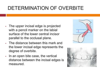  The upper incisal edge is projected
with a pencil marker on the labial
surface of the lower central incisor
parallel to the occlusal plane.
 The distance between this mark and
the lower incisal edge represents the
degree of overbite.
 In an open bite case, the vertical
distance between the incisal edges is
measured.
DETERMINATION OF OVERBITE
 