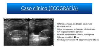 • Riñones normales, sin dilación pelvis renal
• No litiasis vesical
• Vejiga homogénea, sin lesiones intraluminales.
• Sin engrosamiento de paredes
• Próstata aumentada de tamaño, homogénea
• Volumen prostático: 25 cc
• Residuo posmiccional: 45 cc (premiccional 240 cc)
 