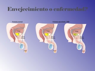 Envejecimiento o enfermedad?
dilatada
Próstata
Vejiga
Uretra
Orina
normal
Próstata
Vejiga
Uretra
dilatada
Próstata
Vejiga
Uretra
Próstata normal Próstata agrandada / HBP
 