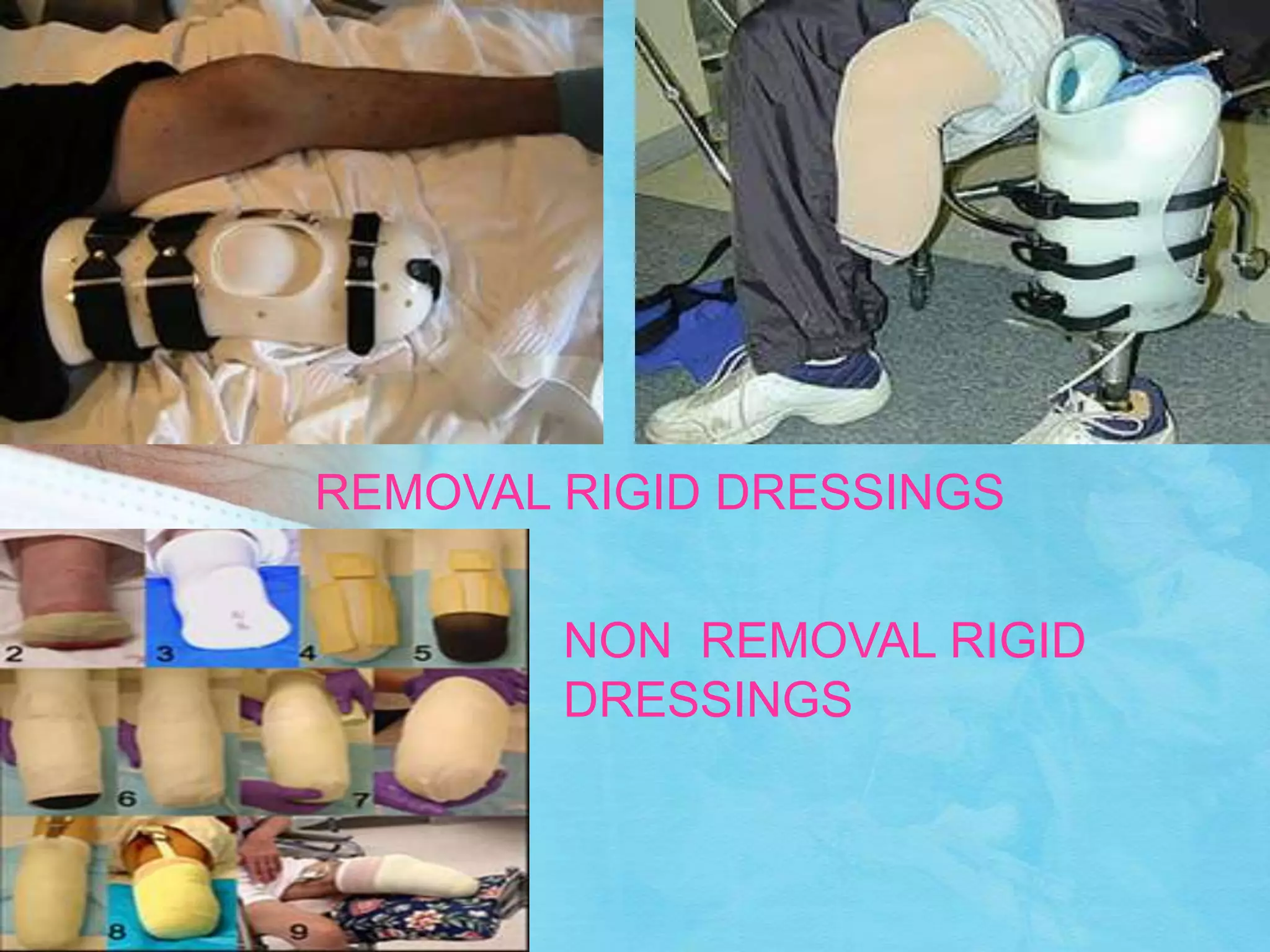 Emovable Rigid Dressing Amputation,Stump care, phantom limb pain and gait training in lower ...