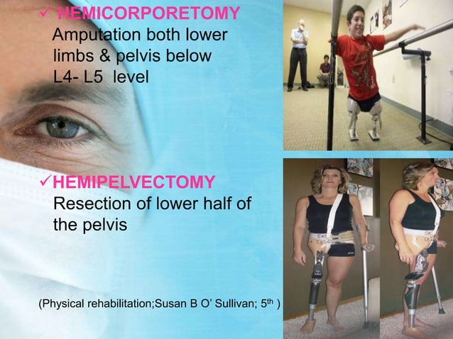 Stump Care.pdf Amputation,Stump care, phantom limb pain and gait training in lower ...