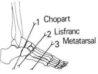 Stump Care.pdf Amputation,Stump care, phantom limb pain and gait training in lower ...