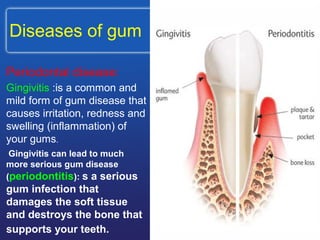 Diseases of gum
Periodontal disease:
Gingivitis :is a common and
mild form of gum disease that
causes irritation, redness and
swelling (inflammation) of
your gums.
Gingivitis can lead to much
more serious gum disease
(periodontitis): s a serious
gum infection that
damages the soft tissue
and destroys the bone that
supports your teeth.
 