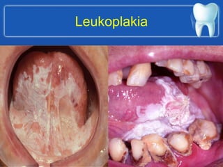 Leukoplakia
 