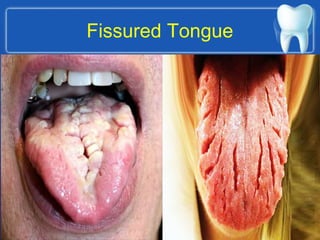Fissured Tongue
 