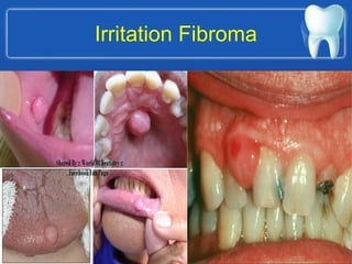 Irritation Fibroma
 