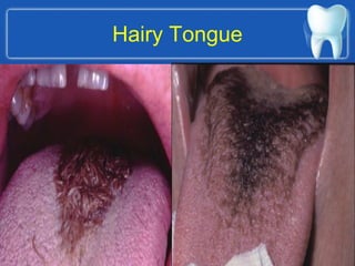 Hairy Tongue
 