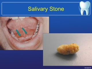 Salivary Stone
 