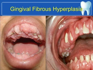Gingival Fibrous Hyperplasia
 