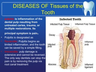 DISEASES OF Tissues of the
Tooth
• pulpitis is inflammation of the
dental pulp resulting from
untreated caries, trauma, or
multiple restorations. Its
principal symptom is pain.
• Pulpitis is designated as
• Reversible: Pulpitis begins as
limited inflammation, and the tooth
can be saved by a simple filling.
• Irreversible: pulp damage is
extensive and cannot be reversed.
The only way dentists can stop the
pain is by removing the pulp via
root canal treatment
 