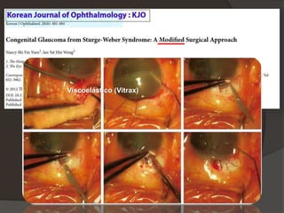 Viscoelástico (Vitrax)
 