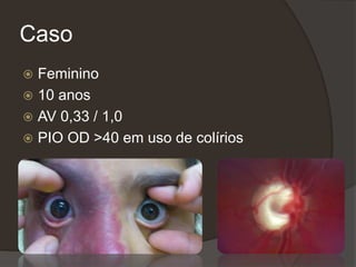 Caso
 Feminino
 10 anos
 AV 0,33 / 1,0
 PIO OD >40 em uso de colírios
 