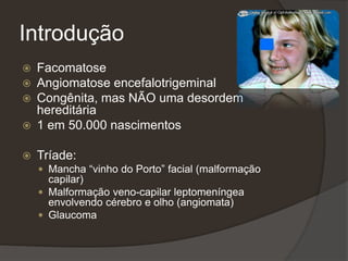 Introdução
 Facomatose
 Angiomatose encefalotrigeminal
 Congênita, mas NÃO uma desordem
hereditária
 1 em 50.000 nascimentos
 Tríade:
 Mancha “vinho do Porto” facial (malformação
capilar)
 Malformação veno-capilar leptomeníngea
envolvendo cérebro e olho (angiomata)
 Glaucoma
 