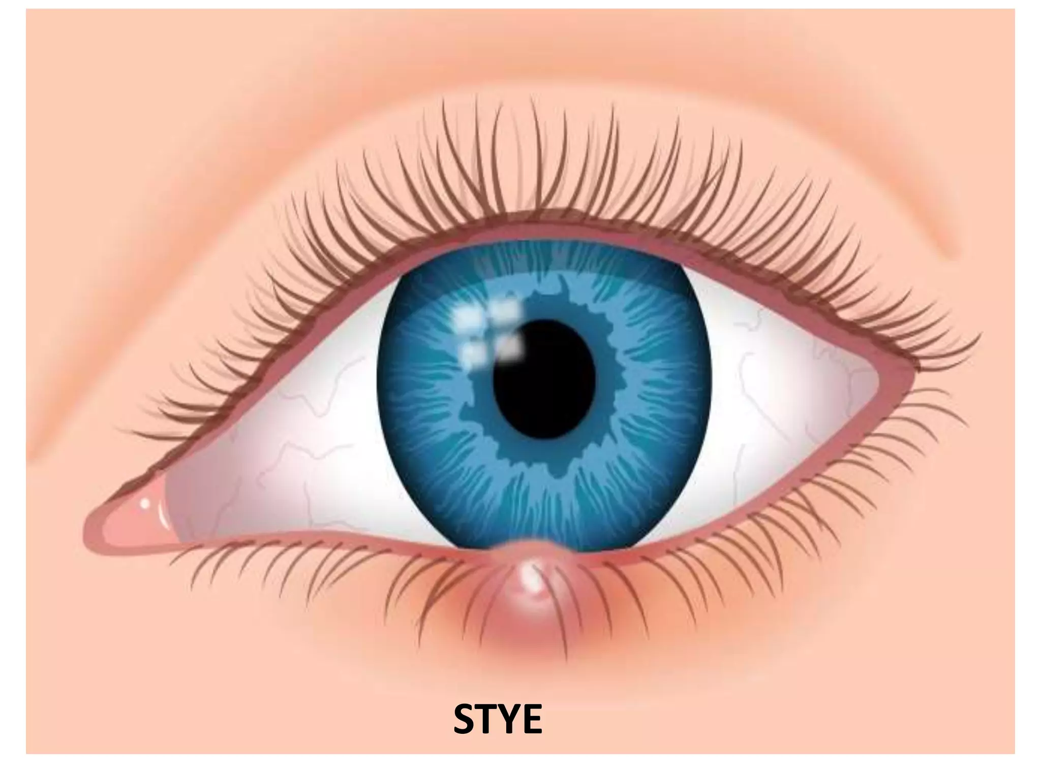 STYE