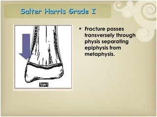 Fracture passes transversely through physis separating epiphysis from metaphysis. Salter Harris Grade I 