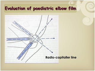 Radio-capitaller line Evaluation of paediatric elbow film 
