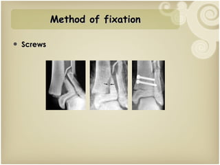 Screws Method of fixation 