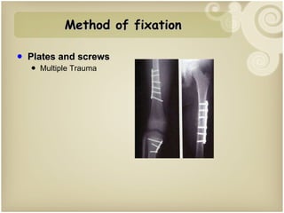 Plates and screws Multiple Trauma Method of fixation 
