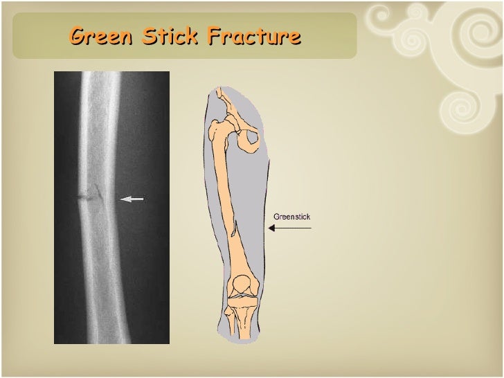 greenstick fracture