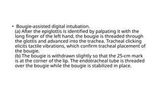 Bougie Injection STYLET and BOUGIE and STERILIZATION techniques used for Intubation | PPTX