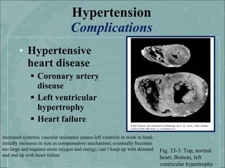 Hypertension
                                  Complications
        • Hypertensive
          heart disease
              ...