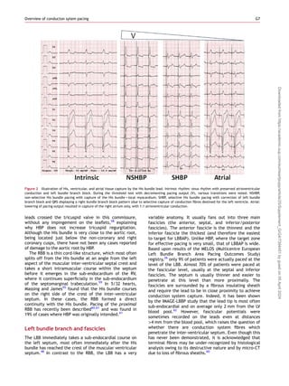 suad114.pdf pacing conduction system pacing | PDF