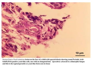 Sub cutaneous fungal infections for mbbs students | PPTX