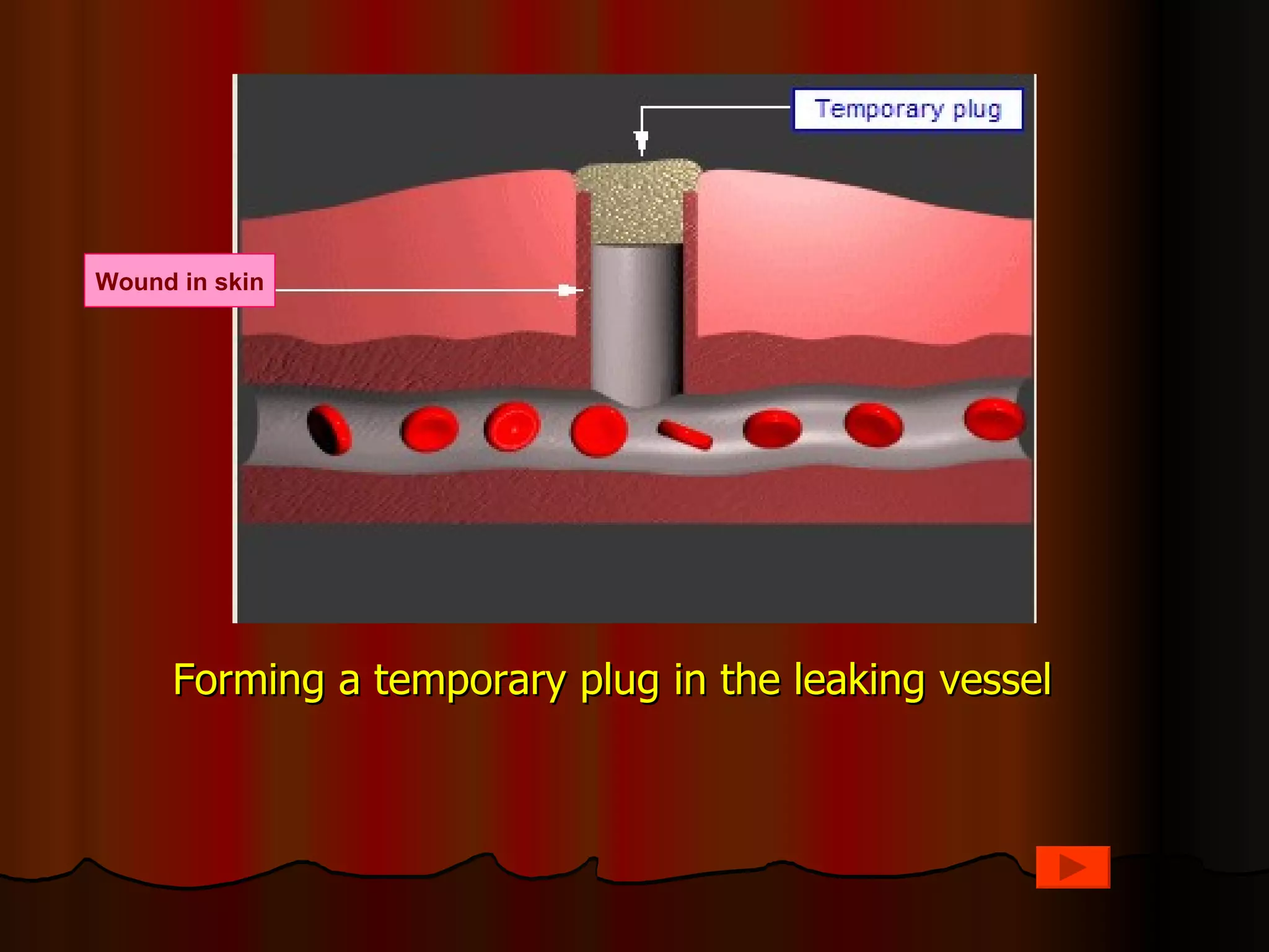 Wound in skin




     Forming a temporary plug in the leaking vessel
 