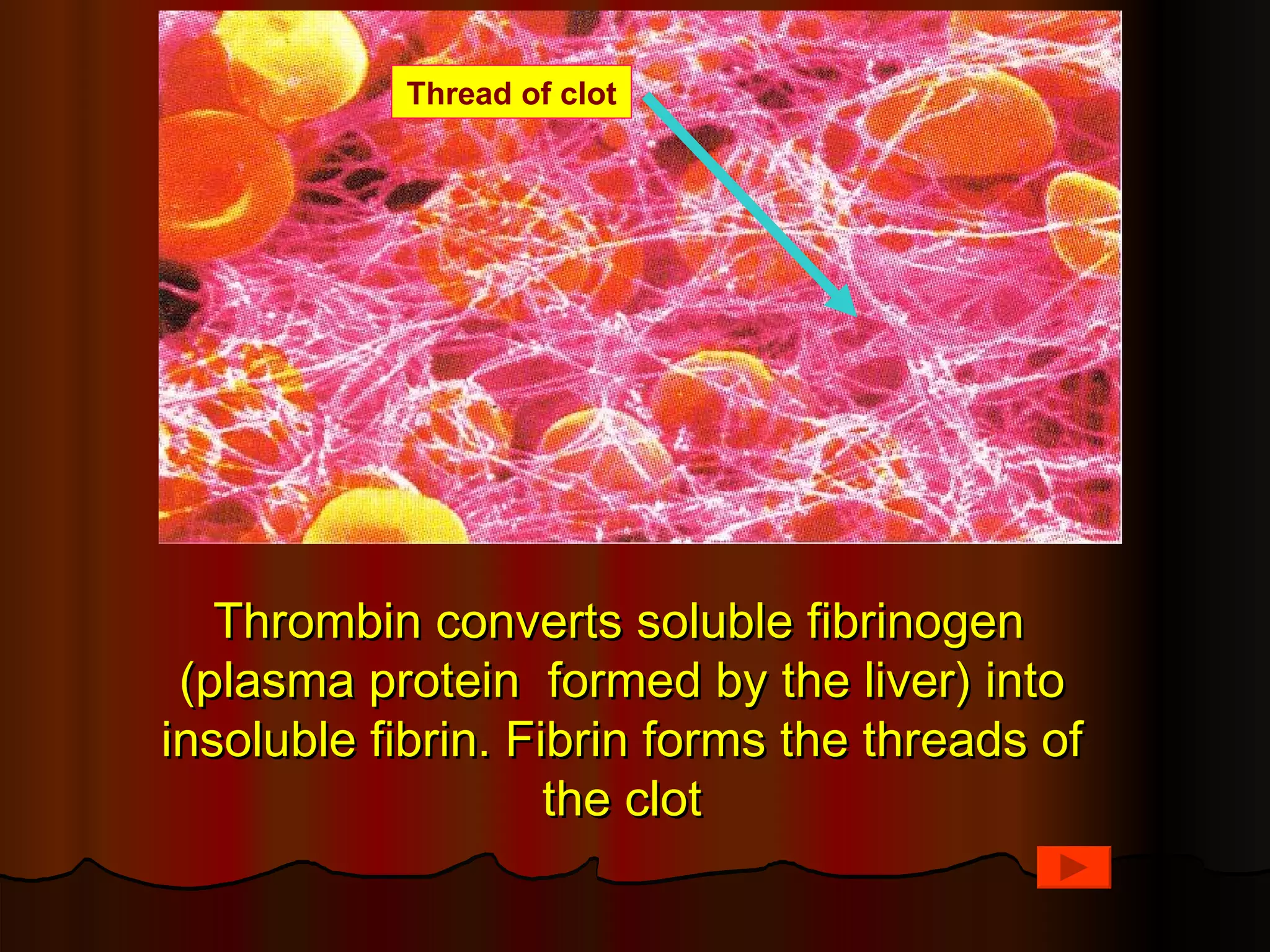 Thread of clot




   Thrombin converts soluble fibrinogen
 (plasma protein formed by the liver) into
insoluble fibrin. Fibrin forms the threads of
                    the clot
 