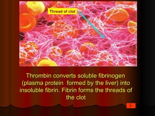 Thread of clot




   Thrombin converts soluble fibrinogen
 (plasma protein formed by the liver) into
insoluble fibrin. Fibrin forms the threads of
                    the clot
 