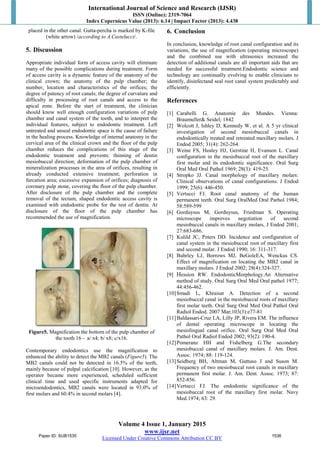 International Journal of Science and Research (IJSR)
ISSN (Online): 2319-7064
Index Copernicus Value (2013): 6.14 | Impact Factor (2013): 4.438
Volume 4 Issue 1, January 2015
www.ijsr.net
Licensed Under Creative Commons Attribution CC BY
placed in the other canal. Gutta-percha is marked by K-file
(white arrow) /according to A.Castelucci/.
5. Discussion
Appropriate individual form of access cavity will eliminate
many of the possible complications during treatment. Form
of access cavity is a dynamic feature of the anatomy of the
clinical crown; the anatomy of the pulp chamber; the
number, location and characteristics of the orifices; the
degree of patency of root canals; the degree of curvature and
difficulty in processing of root canals and access to the
apical zone. Before the start of treatment, the clinician
should know well enough configuration variations of pulp
chamber and canal system of the tooth, and to interpret the
individual features, subject to endodontic treatment. Left
untreated and unseal endodontic space is the cause of failure
in the healing process. Knowledge of internal anatomy in the
cervical area of the clinical crown and the floor of the pulp
chamber reduces the complications of this stage of the
endodontic treatment and prevents: thinning of dentin
mesiobuccal direction; deformation of the pulp chamber of
mineralization processes in the area of orifices, resulting in
already conducted extensive treatment; perforation in
furcation area; excessive expansion of orifices; diagnosis of
coronary pulp stone, covering the floor of the pulp chamber.
After disclosure of the pulp chamber and the complete
removal of the tectum, shaped endodontic access cavity is
examined with endodontic probe for the rest of dentin. At
disclosure of the floor of the pulp chamber has
recommended the use of magnification.
Figure5. Magnification the bottom of the pulp chamber of
the tooth 16 - a/ x4; b/ x8; c/x16.
Contemporary endodontics use the magnification to
enhanced the ability to detect the MB2 canals (Figure5). The
MB2 canals could not be detected in 16.5% of the teeth,
mainly because of pulpal calcification [10]. However, as the
operator became more experienced, scheduled sufficient
clinical time and used specific instruments adapted for
microendodontics, MB2 canals were located in 93.0% of
first molars and 60.4% in second molars [4].
6. Conclusion
In conclusion, knowledge of root canal configuration and its
variations, the use of magnification (operating microscope)
and the combined use with ultrasonics increased the
detection of additional canals are all important aids that are
needed for successful treatment.Endodontic science and
technology are continually evolving to enable clinicians to
identify, disinfectand seal root canal system predictably and
efficiently.
References
[1] Carabelli G. Anatomie des Mundes. Vienna:
Braumuller& Seidel; 1842
[2] Wolcott J, Ishley D, Kennedy W, et al. A 5 yr clinical
investigation of second mesiobuccal canals in
endodontically treated and retreated maxillary molars. J
Endod 2005; 31(4): 262-264.
[3] Weine FS, Healey HJ, Gerstine H, Evanson L. Canal
configuration in the mesiobuccal root of the maxillary
first molar and its endodontic significance. Oral Surg
Oral Med Oral Pathol 1969; 28(3): 419-25.
[4] Stropko JJ. Canal morphology of maxillary molars:
Clinical observations of canal configurations. J Endod
1999; 25(6): 446-450.
[5] Vertucci FJ. Root canal anatomy of the human
permanent teeth. Oral Surg OralMed Oral Parhol 1984;
58:589-599
[6] Gorduysus M, Gorduysus, Friedman S. Operating
microscope improves negotiation of second
mesiobuccal canals in maxillary molars, J Endod 2001;
27:683-686.
[7] Kulild JC, Peters DD. Incidence and configuration of
canal system in the mesiobuccal root of maxillary first
and second molar. J Endod 1990; 16: 311-317.
[8] Buhrley LJ, Borrows MJ, BeGoleEA, Wenckus CS.
Effect of magnification on locating the MB2 canal in
maxillary molars. J Endod 2002; 28(4):324-327.
[9] Hession RW. EndodonticMorphology.An Alternative
method of study. Oral Surg Oral Med Oral pathol 1977;
44:456-462.
[10]Smadi L, Khraisat A. Detection of a second
mesiobuccal canal in the mesiobuccal roots of maxillary
first molar teeth. Oral Surg Oral Med Oral Pathol Oral
Radiol Endod. 2007 Mar;103(3):e77-81
[11]Baldassari-Cruz LA, Lilly JP, Rivera EM. The influence
of dental operating microscope in locating the
mesiolingual canal orifice. Oral Surg Oral Med Oral
Pathol Oral Radiol Endod 2002; 93(2): 190-4.
[12]Pomeranz HH and Fishelberg G.The secondary
mesiobuccal canal of maxillary molars. J. Am. Dent.
Assoc. 1974; 88: 119-124.
[13]Seidberg BH, Altman M, Guttuso J and Suson M.
Frequency of two mesiobuccal root canals in maxillary
permanent first molar. J. Am. Dent. Assoc. 1973; 87:
852-856.
[14]Vertucci FJ. The endodontic significance of the
mesiobuccal root of the maxillary first molar. Navy
Med.1974; 63: 29.
Paper ID: SUB1535 1536
 