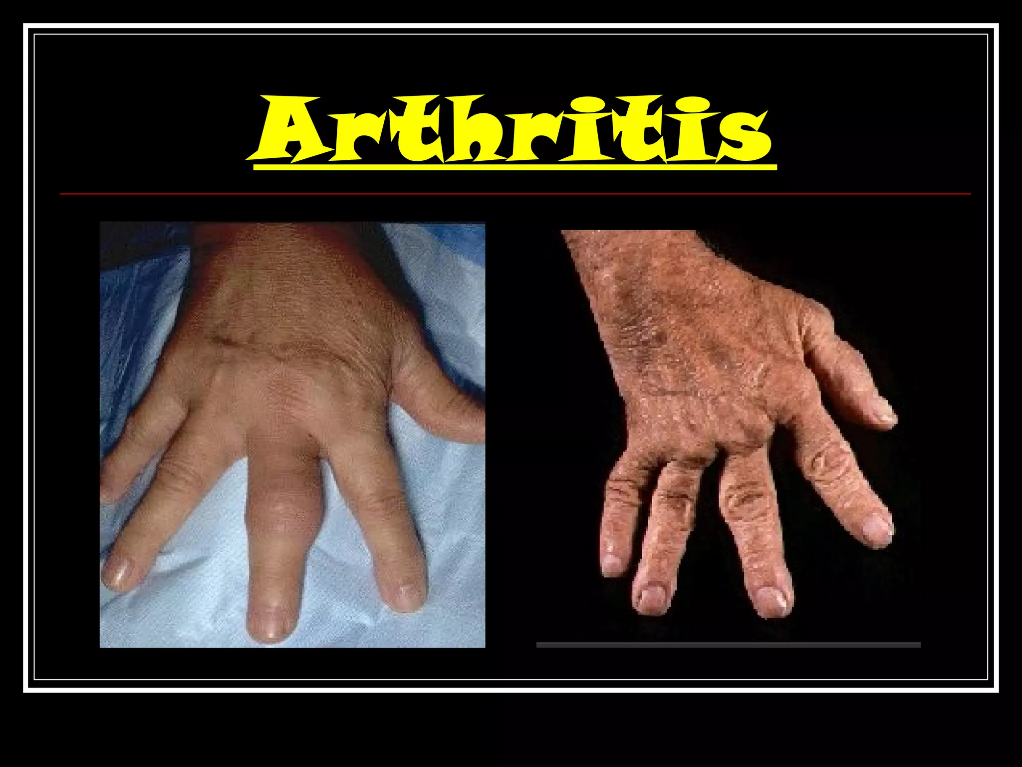 Arthritis
 