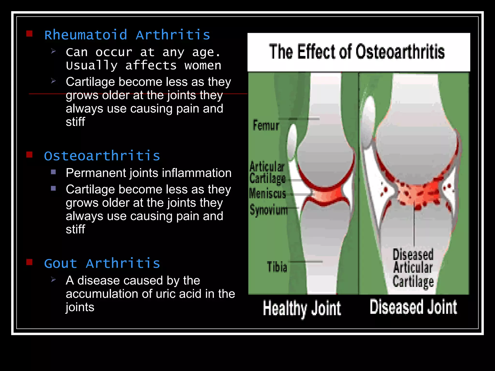    Rheumatoid Arthritis
       Can occur at any age.
        Usually affects women
       Cartilage become less as they
        grows older at the joints they
        always use causing pain and
        stiff

   Osteoarthritis
       Permanent joints inflammation
       Cartilage become less as they
        grows older at the joints they
        always use causing pain and
        stiff

   Gout Arthritis
       A disease caused by the
        accumulation of uric acid in the
        joints
 
