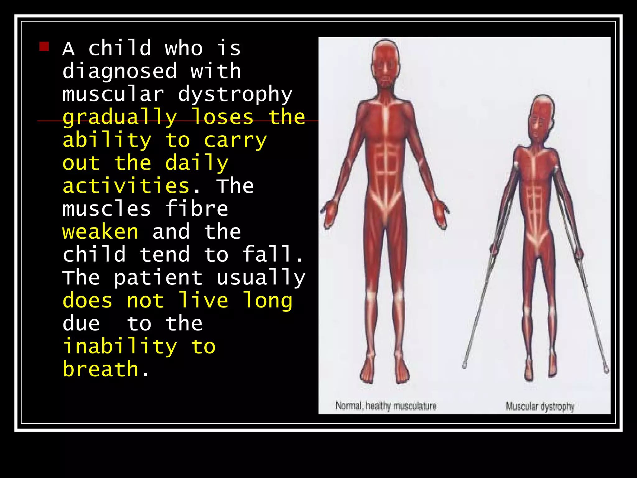    A child who is
    diagnosed with
    muscular dystrophy
    gradually loses the
    ability to carry
    out the daily
    activities. The
    muscles fibre
    weaken and the
    child tend to fall.
    The patient usually
    does not live long
    due to the
    inability to
    breath.
 