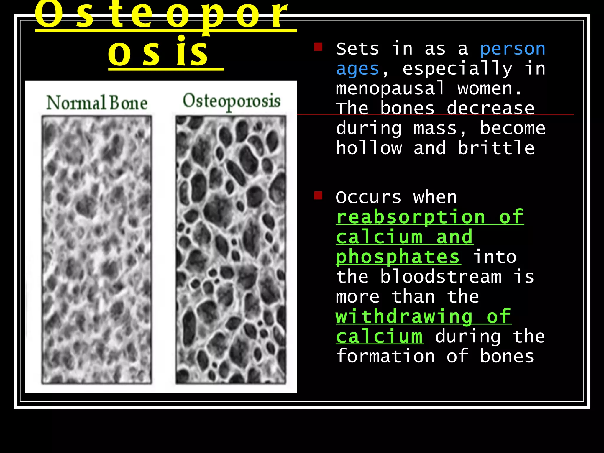 O s te o p o r
    o s is          Sets in as a person
                     ages, especially in
                     menopausal women.
                     The bones decrease
                     during mass, become
                     hollow and brittle

                    Occurs when
                     reabsorption of
                     calcium and
                     phosphates into
                     the bloodstream is
                     more than the
                     withdrawing of
                     calcium during the
                     formation of bones
 