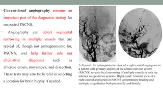 Differential Diagnosis of Subacute Brainstem Insults | PPTX