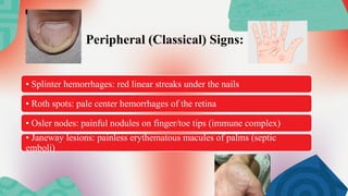 Comprehensive Overview of Subacute Infective Endocarditis: Diagnosis ...