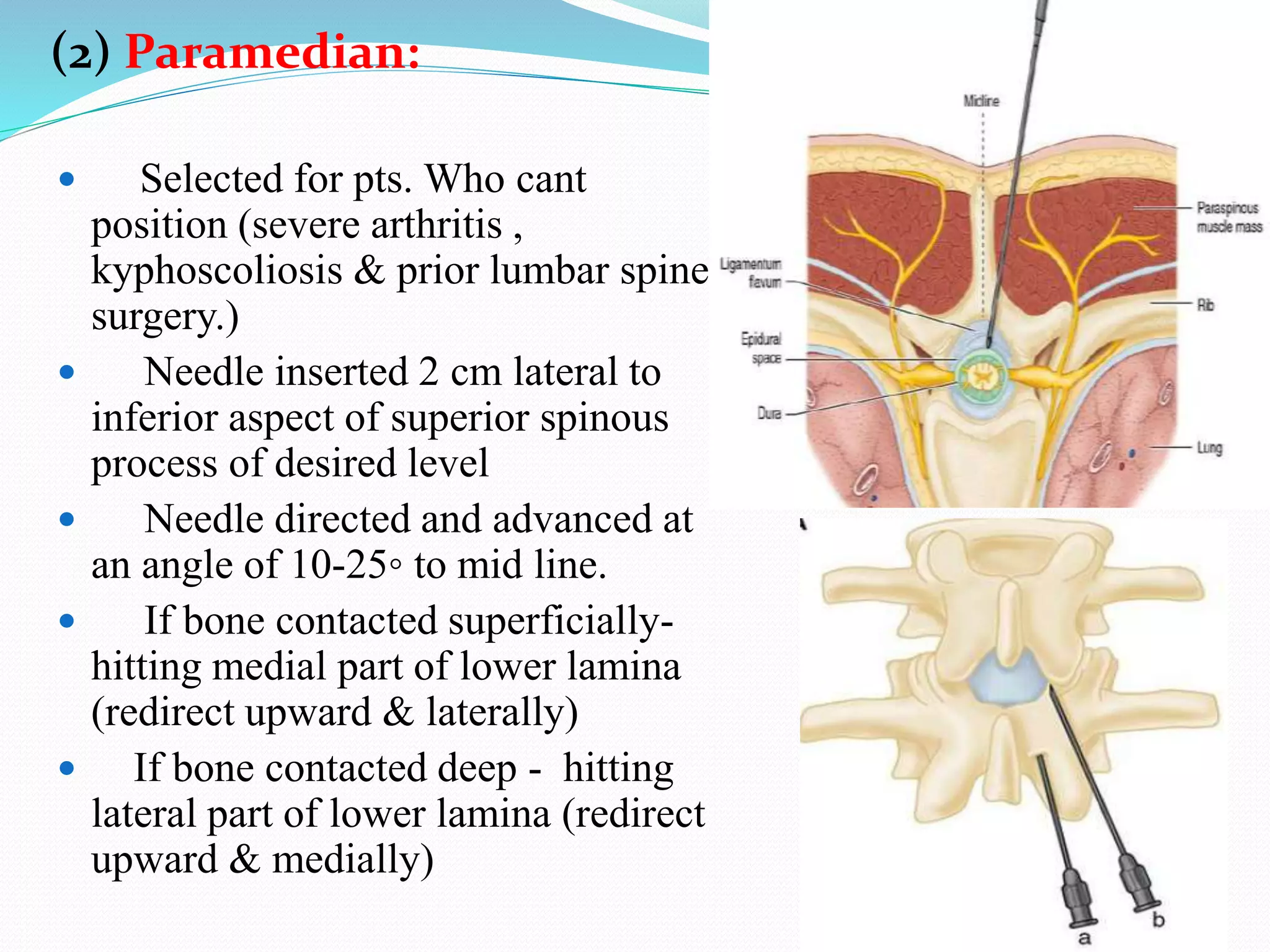 (2) Paramedian:
 Selected for pts. Who cant
position (severe arthritis ,
kyphoscoliosis & prior lumbar spine
surgery.)
 Needle inserted 2 cm lateral to
inferior aspect of superior spinous
process of desired level
 Needle directed and advanced at
an angle of 10-25◦ to mid line.
 If bone contacted superficially-
hitting medial part of lower lamina
(redirect upward & laterally)
 If bone contacted deep - hitting
lateral part of lower lamina (redirect
upward & medially)
 
