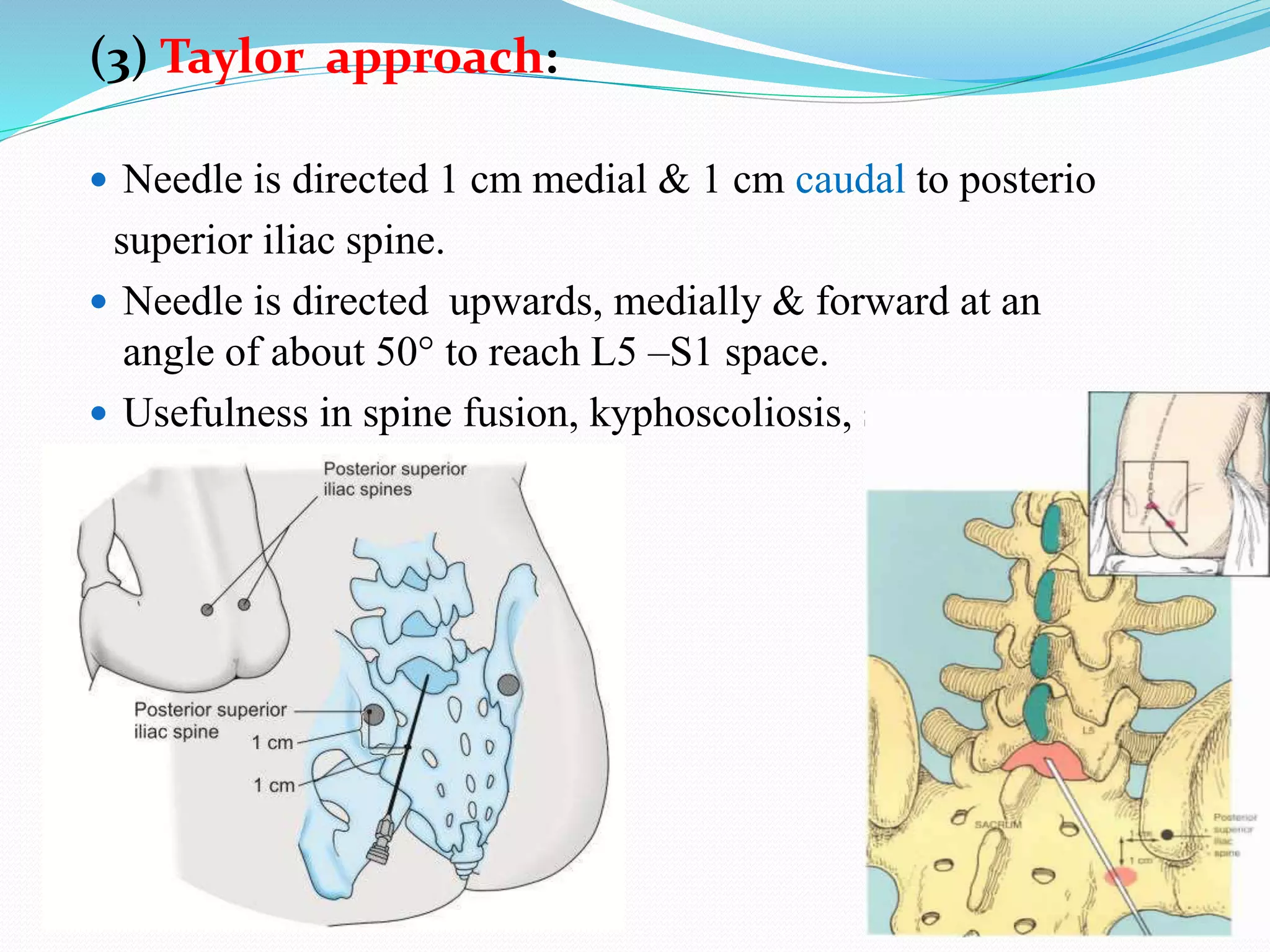 (3) Taylor approach:
 Needle is directed 1 cm medial & 1 cm caudal to posterio
superior iliac spine.
 Needle is directed upwards, medially & forward at an
angle of about 50° to reach L5 –S1 space.
 Usefulness in spine fusion, kyphoscoliosis, skin infection
in lumbar region.
 