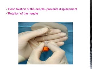 Good fixation of the needle -prevents displacement
Rotation of the needle
 