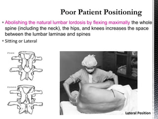  Abolishing the natural lumbar lordosis by flexing maximally the whole
spine (including the neck), the hips, and knees increases the space
between the lumbar laminae and spines
 Sitting or Lateral
Lateral Position
 