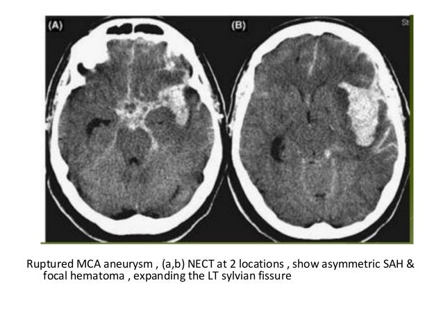subarachnoid hemorrhage Management of aneurysmal subarachnoid hemorrhage: state of the art and future perspectives giovanni grasso, concetta alafaci1, r loch macdonald2,3. subarachnoid hemorrhage Management of aneurysmal subarachnoid hemorrhage: state of the art and future perspectives giovanni grasso, concetta alafaci1, r loch macdonald2,3.