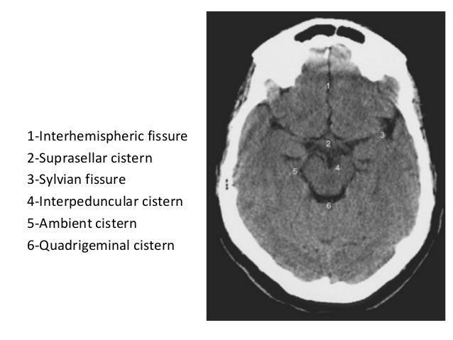 Diagnostic Imaging of Subarachnoid Hemorrhage